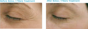 Before and after pictures of a woman eyes