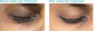 Before and after pictures of a woman eyes-Best Skin Clinic Chennai-