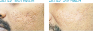 Acne scars before and after treatment-Best Skin Clinic Chennai