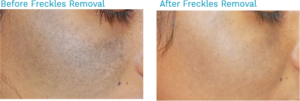 A woman's skin before and after treatment-Laser Skin Treatment Chennai