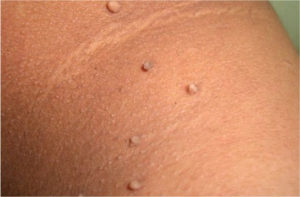 A close up of a person's skin with small bumps-Best Skin Clinic Chennai