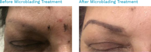 A woman's eyebrows before and after a microblading treatment-Laser Skin Treatment Chennai