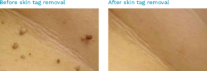 A picture of a woman's skin before and after a treatment-Laser Skin Treatment Chennai