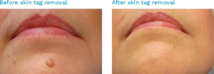 Before and after pictures of a woman's lips-Best Skin Clinic Chennai-