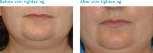 Before and after pictures of skin tightening treatment