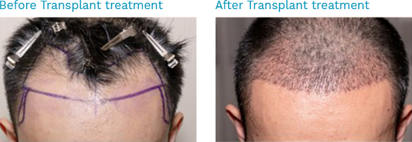 Best Hair Transplant in Chennai