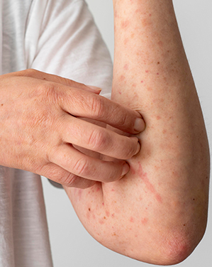 Skin Tag: Causes, Types and Treatment