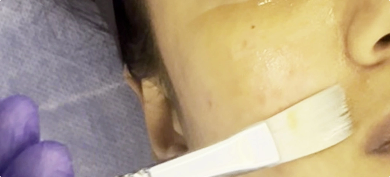 Skin Tightening Treatment Chennai