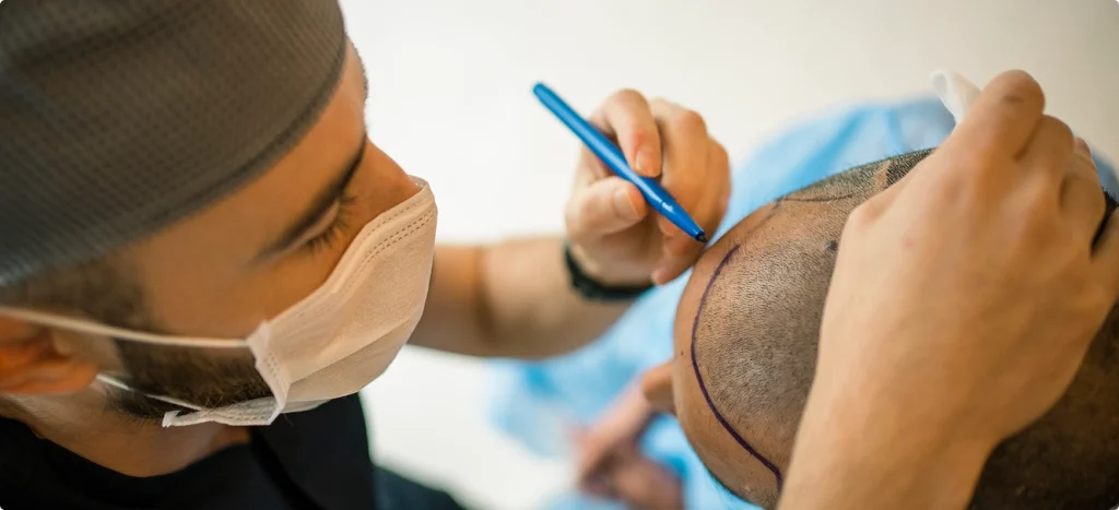 Hair Transplant Clinic Alwarpet