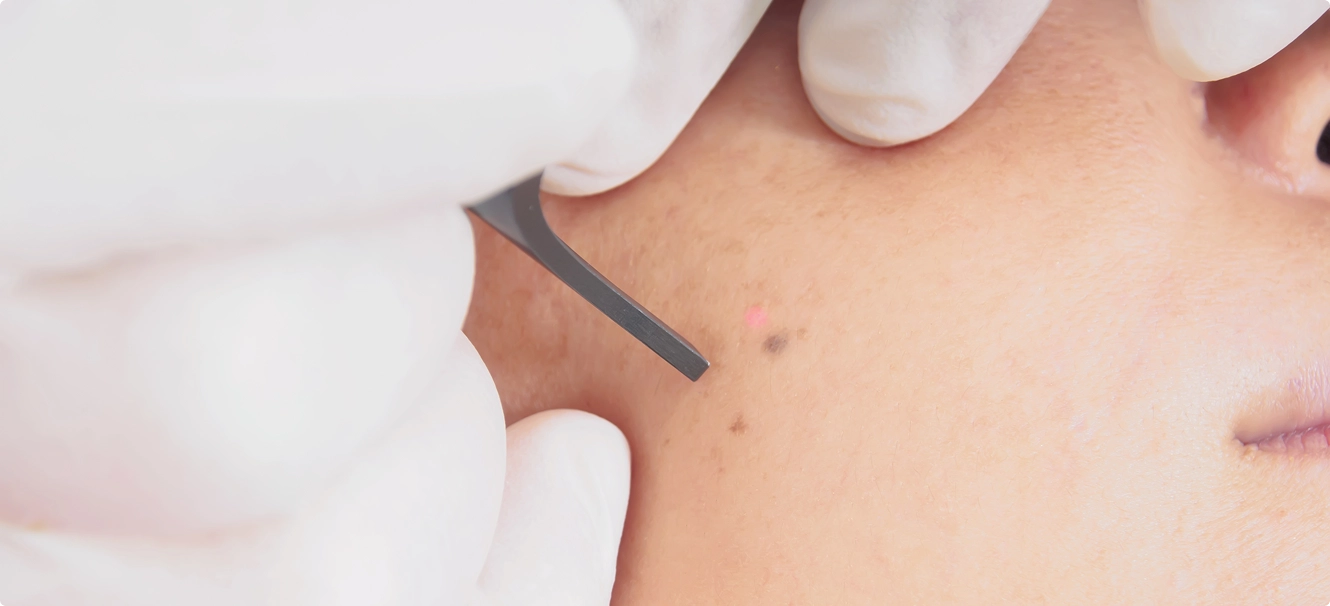 Best Skin Treatment in Chennai