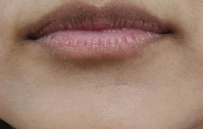 Pigmentation Removal Treatment Porur