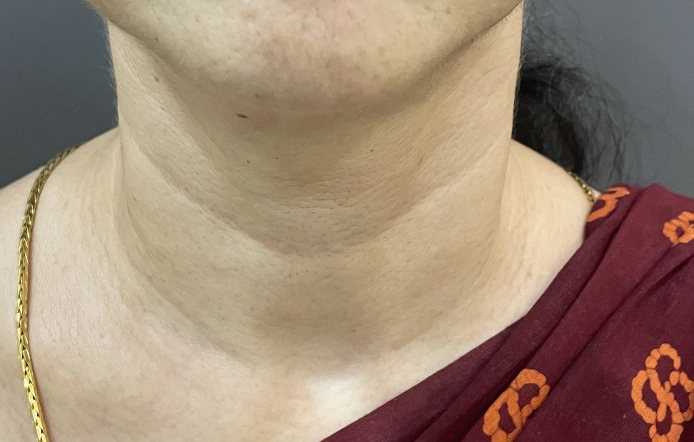 Anti-Ageing Treatment Chennai