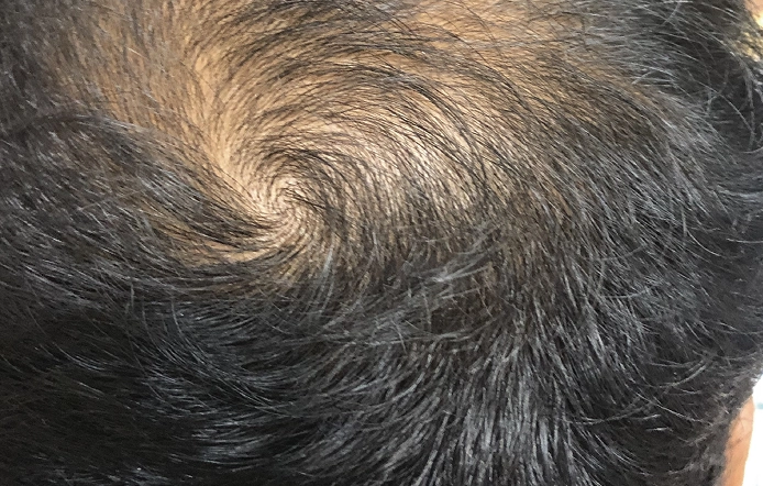Hair Transplant Clinic Alwarpet