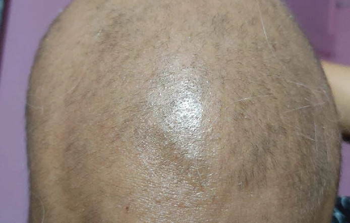 Hair Fall Treatment Guindy