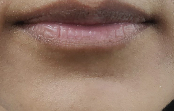 Pigmentation Removal Treatment Porur