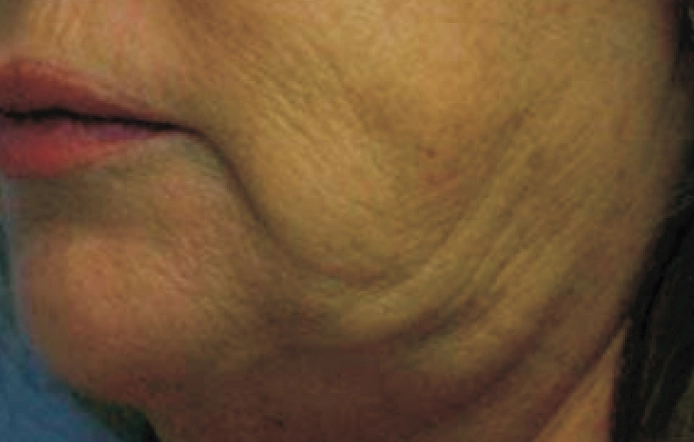 Anti-Ageing Treatment Chennai