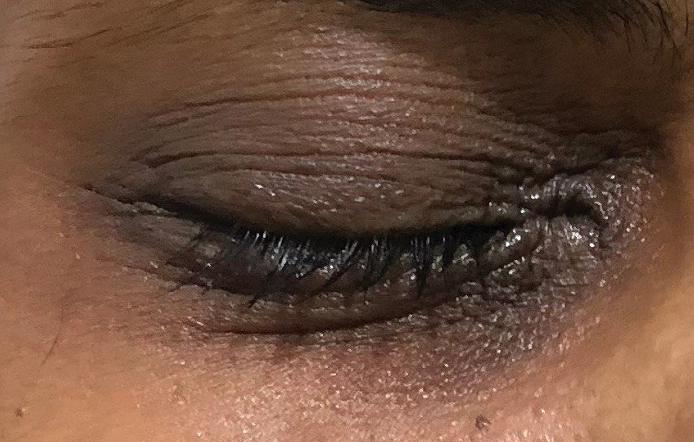 Pigmentation Removal Treatment Porur
