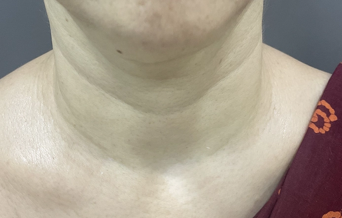 Anti-Ageing Treatment Chennai
