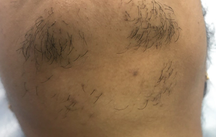 Derma Filler Treatment Chennai