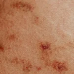 Psoriasis Treatment in Besant Nagar