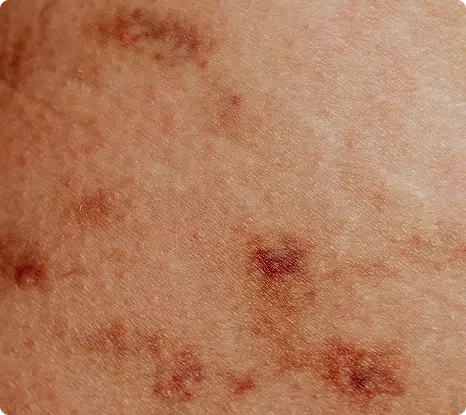 Psoriasis Treatment