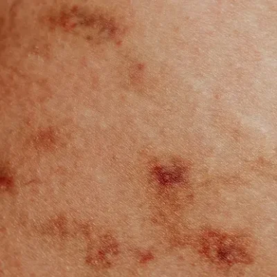Psoriasis Treatment in Besant Nagar